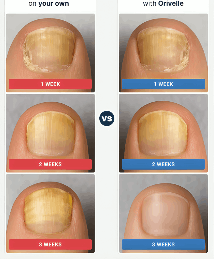 Orrivell Nail Fungus Pen before and after – Orrivell
